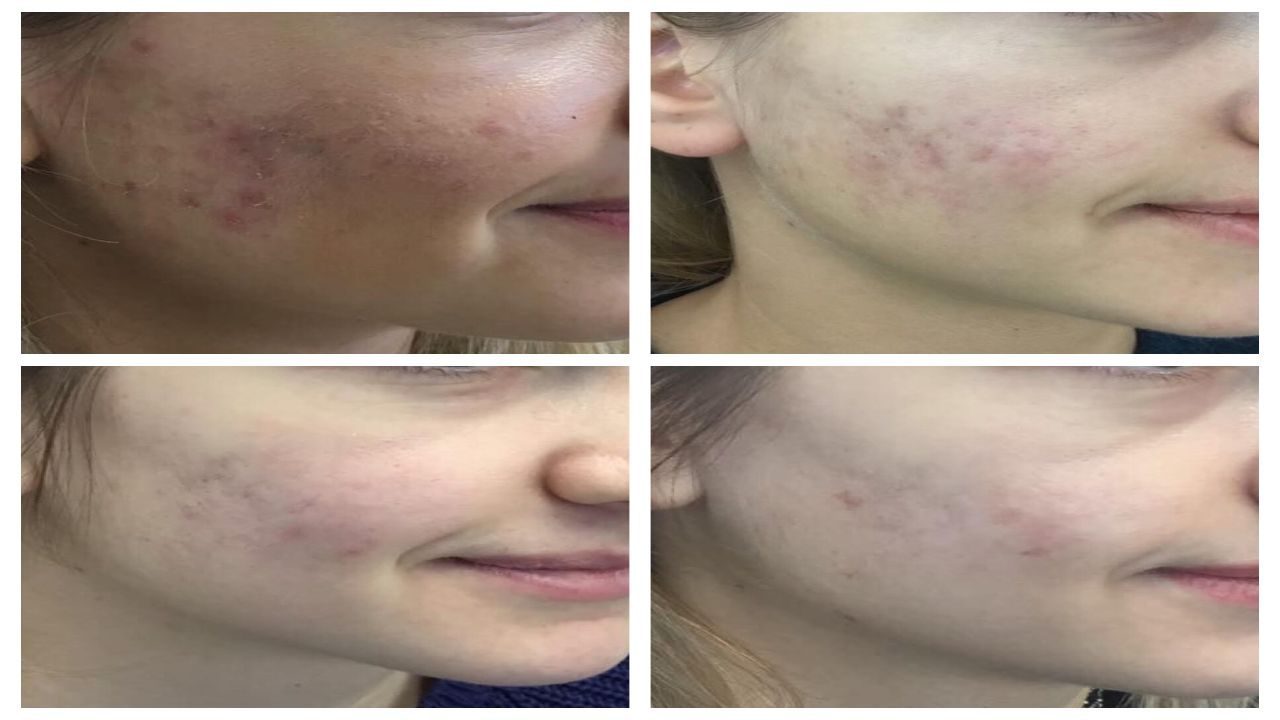 Treats Acne and Acne Scarring